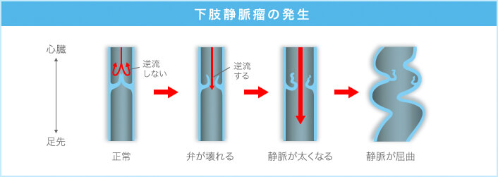 宮田整形外科 下肢静脈瘤